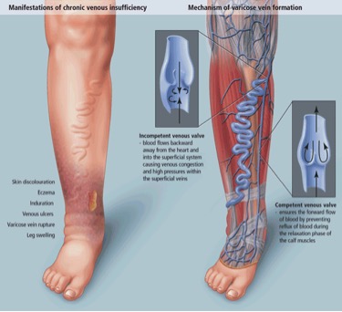 Venous Insufficiency Overview | Treatment of Venous Insufficiency